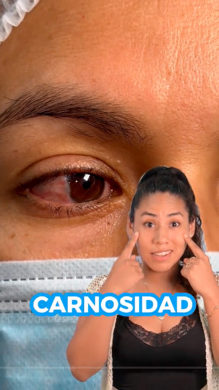 Eliminar esa carnosidad en tus ojos es posible