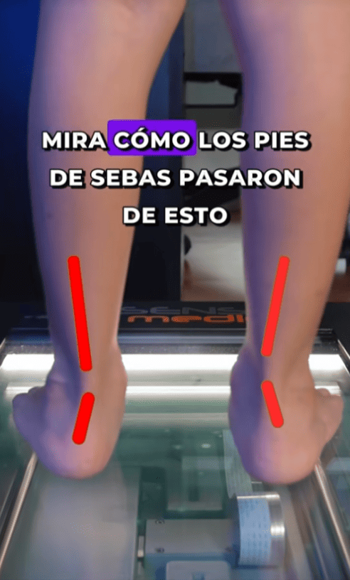 Mira como corregimos los pies de nuestro pacientito